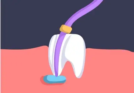 Unveiling the process of a root canal treatment